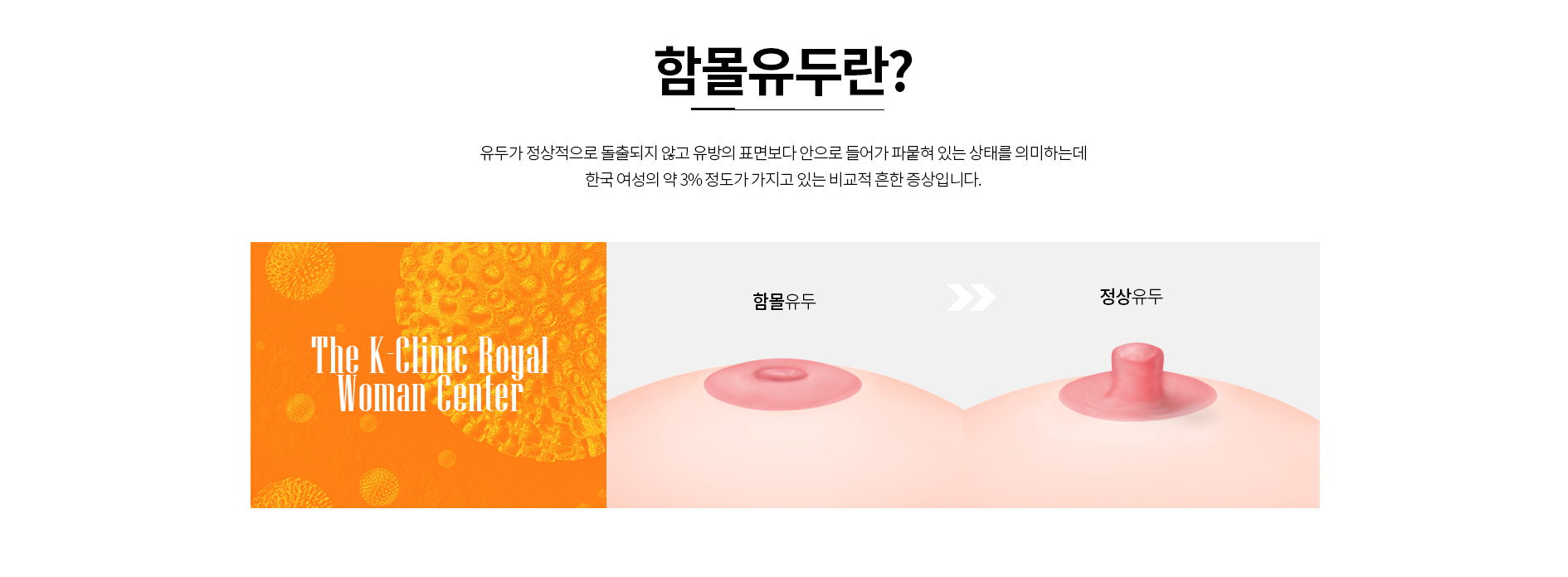 함몰유두란? 유두가 정상적으로 돌출되지 않고 유방의 표면보다 안으로 들어가 파뭍혀 있는 상태를 의미하는데 한국 여성의 약 3% 정도가 가지고 있는 비교적 흔한 증상입니다.