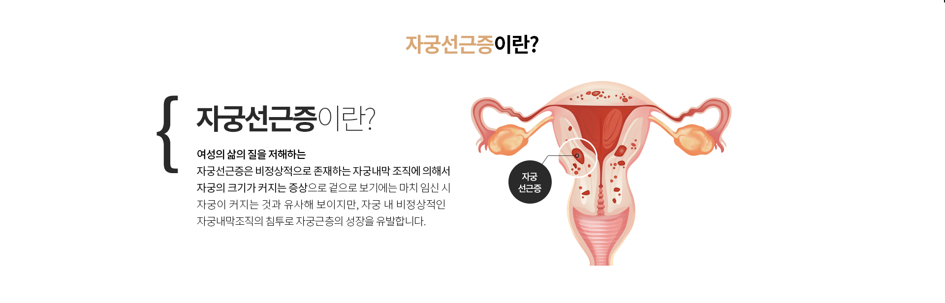 자궁선근증이란?