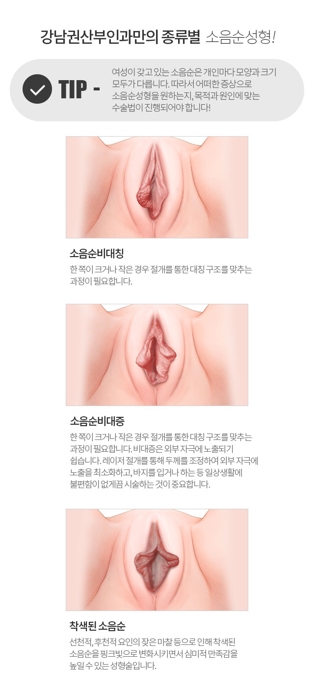 강남권산부인과만의 종류별 소음순성형